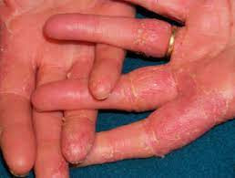 Dermatitis Kontak Iritan